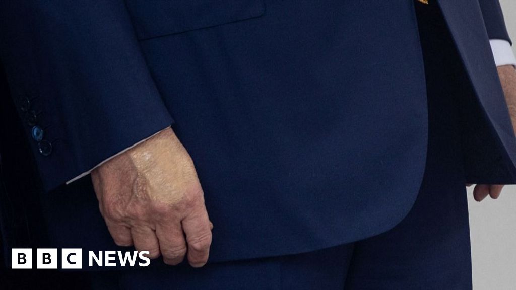 White House says Trump diagnosed with vein condition