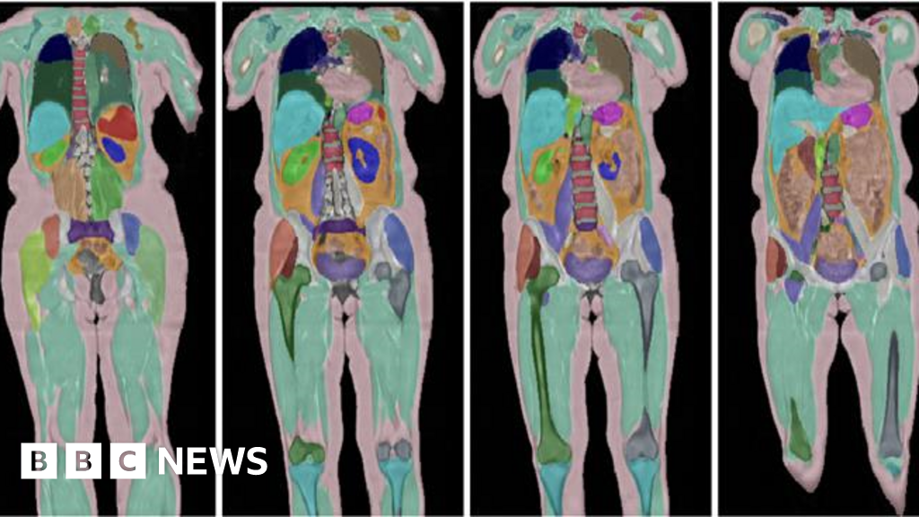 Biggest human imaging study scans 100,000th UK volunteer