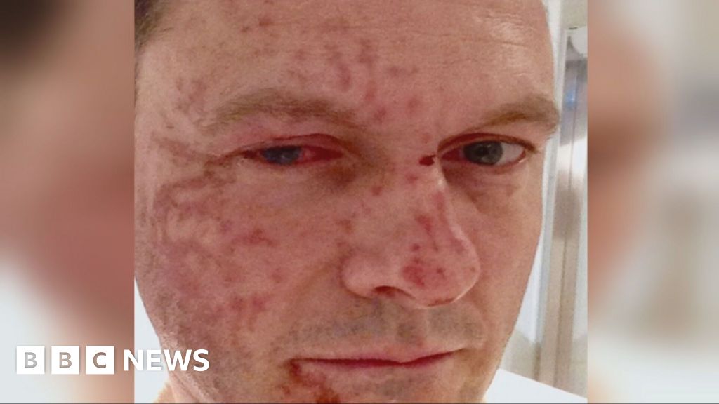 Tory leader relives acid attack as he hits out at parole system Tory leader relives acid attack as he hits out at parole system